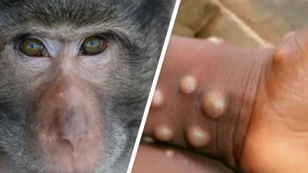 Число заражений оспой обезьян среди людей по всему миру выросло на 77% с прошлой недели - ВОЗ