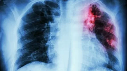 На 16% выросла заболеваемость туберкулезом в СКО