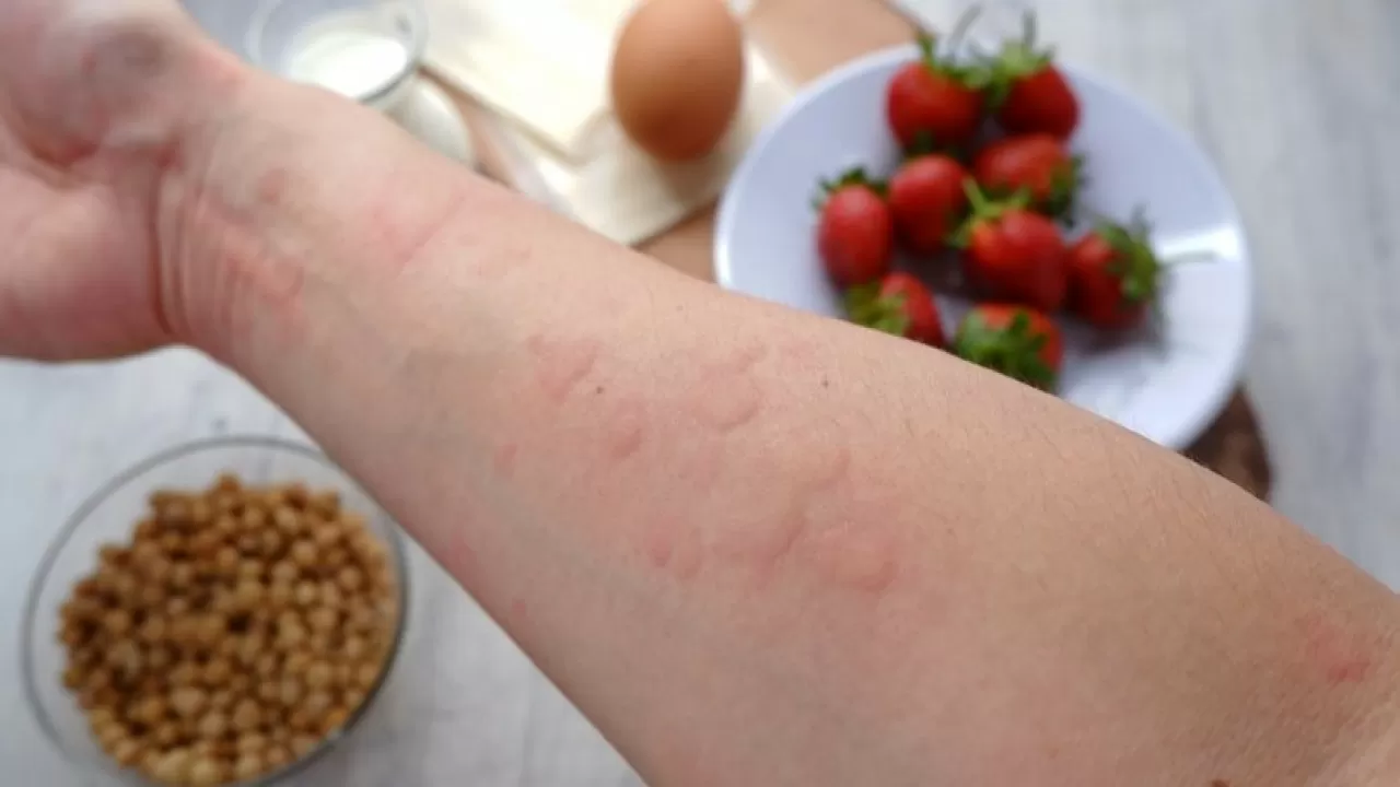 Дәрігер кеңесі: Аллергияны қалай анықтауға болады