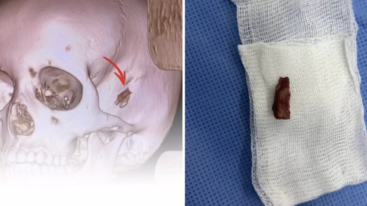 Павлодарда баланың басынан 5 жыл бұрын кіріп кеткен бұтақтың бір бөлігі алынды