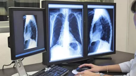 Елде өкпе обырына міндетті скрининг енгізілуі мүмкін   