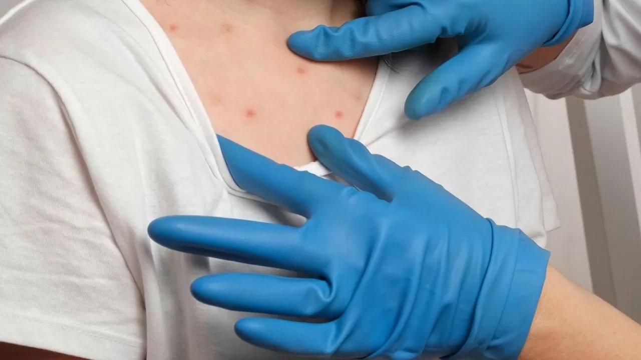 В Казахстане вспышка кори: почти 2 тыс. случаев за месяц 