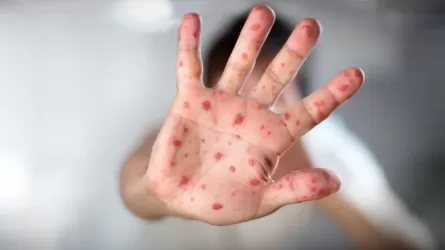 Меры по борьбе с корью усиливают в СКО 