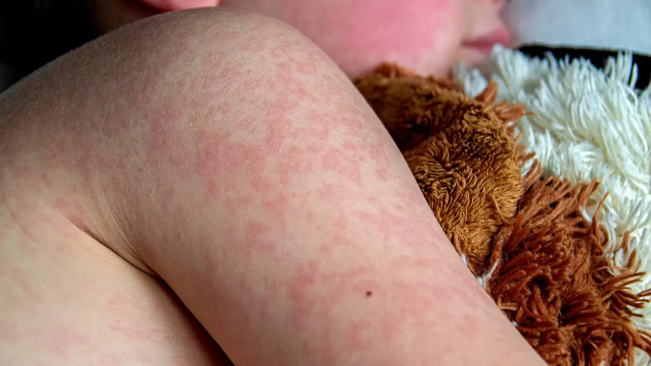 В Казахстане стремительно растет заболеваемость корью