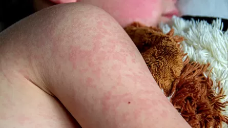 В Казахстане стремительно растет заболеваемость корью