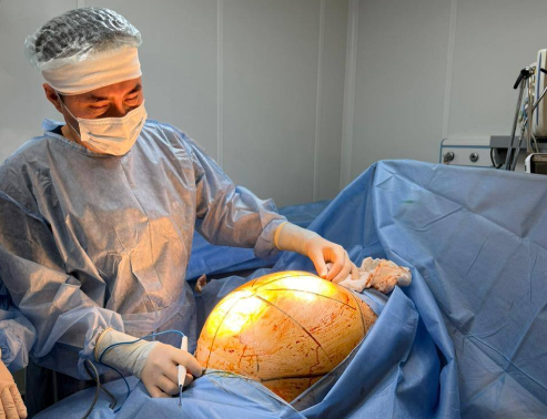 Опухоль весом 25 кг женщина пыталась вылечить БАДами 