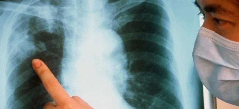 В Астане выросла смертность от туберкулеза  