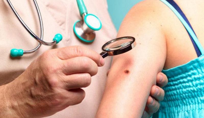 В Нур-Султане можно бесплатно пройти обследование на рак кожи   