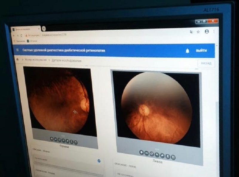 В Нур-Султане тестируют новый способ диагностики заболевания глаз с использованием технологий искусственного интеллекта   