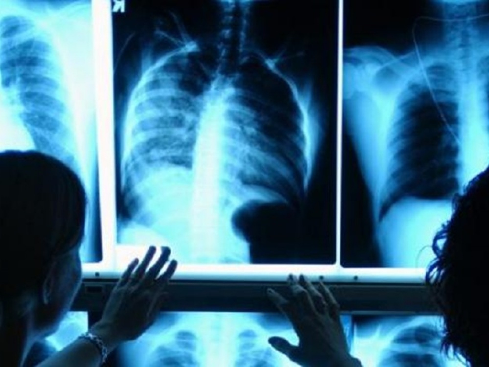 Ақтөбе облысында 29 студент пен 27 оқушыдан туберкулез белгілері анықталды