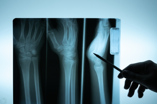 Британские клиники расшифровывают рентгеновские снимки в Австралии из-за дефицита рентгенологов 